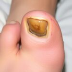 How to Tell If You Have Toenail Fungus or Just a Damaged Nail