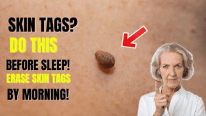 This Weird Trick Removes Skin Tags Overnight (So Simple!)