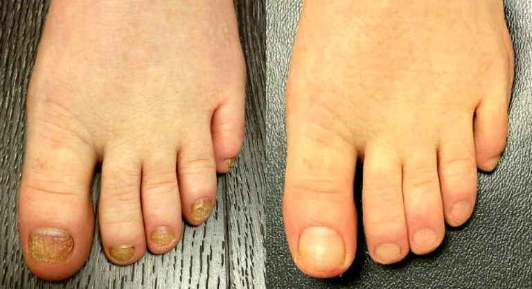 Best Otc Cure For Toenail Fungus 