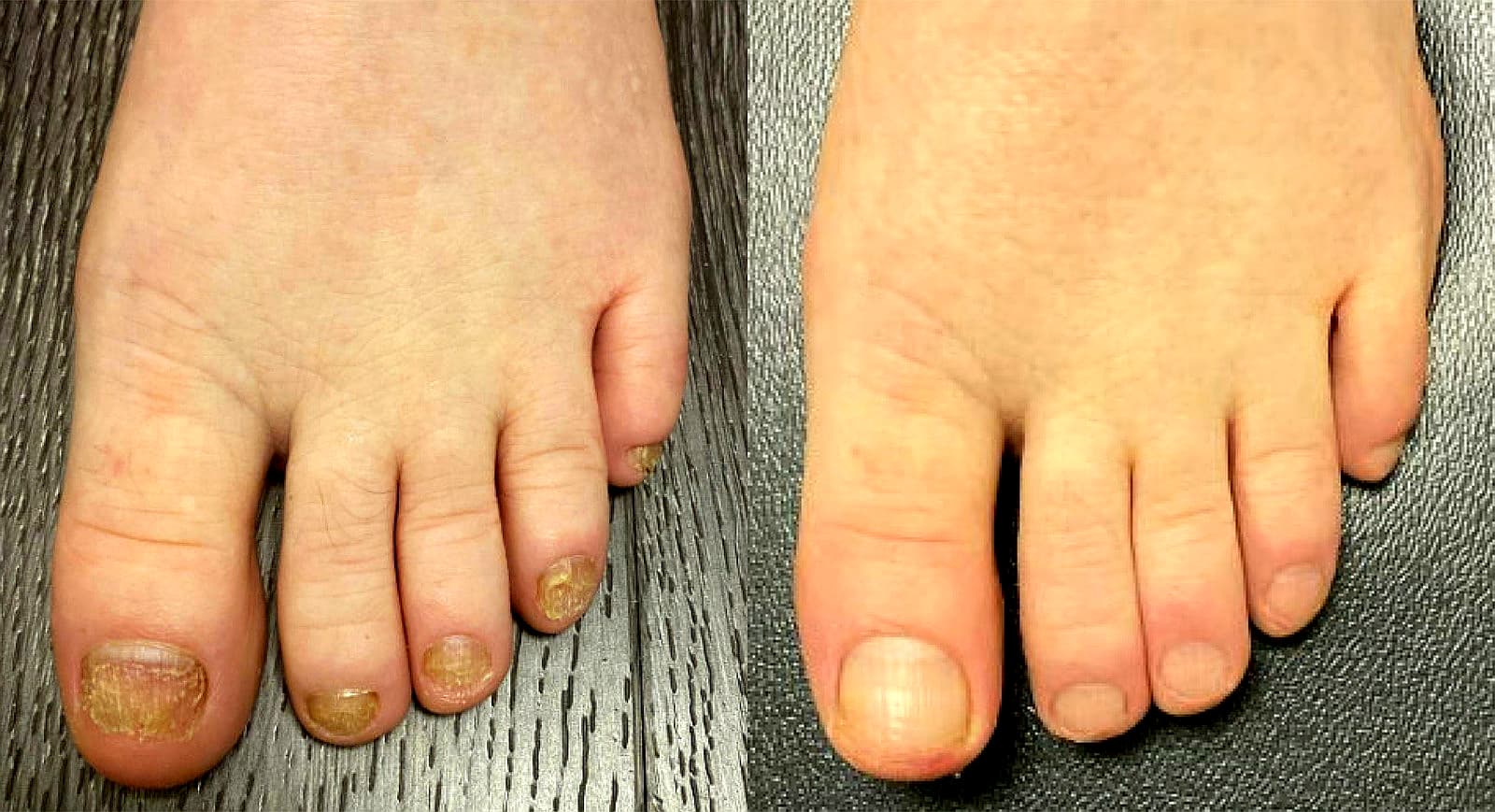 What’s Working for People With Stubborn Toenail Issues: So Simple 1 I Felt Ashamed—Then This 2-Minute Trick Restored My Healthy Nails