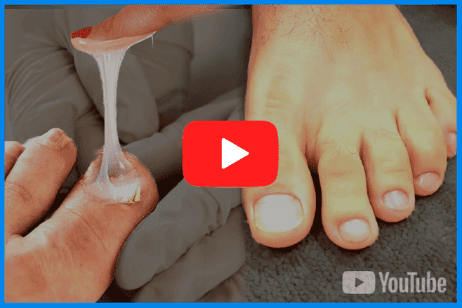 What’s Working for People With Stubborn Toenail Issues: So Simple 2 Why Are You Still Struggling With Unsightly Toenails?