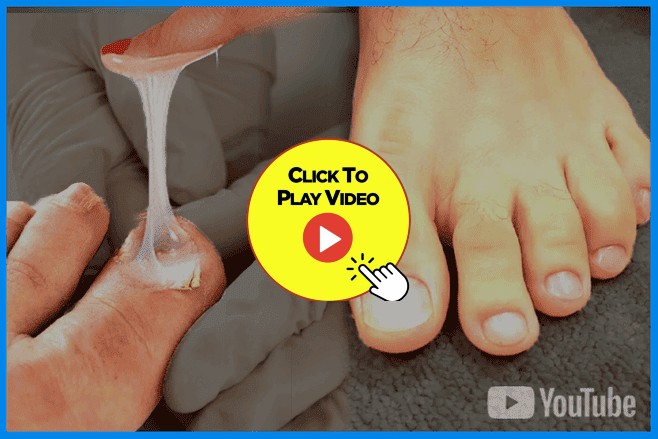 Toenail Fungus Removal: What Your Nails Crave (And How to Get It) 2 Why Are You Still Struggling With Unsightly Toenails?