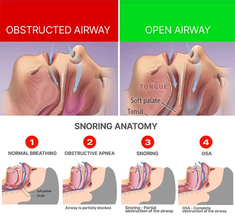 DreamHero Mouthguard Review: Do Not Buy Till You’ve Read This! 4 The Science Behind DreamHero’s Effectiveness